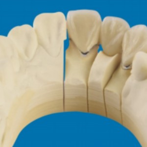 Fém-porcelán fogak